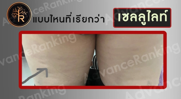 ปัญหาเซลลูไลท์