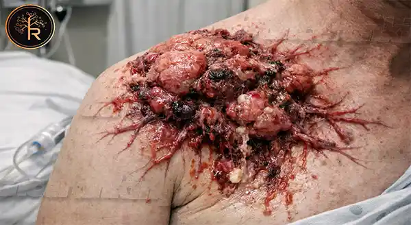 มะเร็งร้าย ตายเร็ว จริงหรือไม่